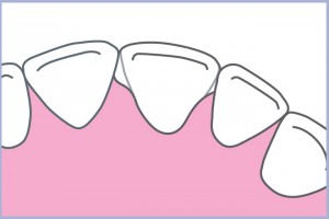Fig. 23 - Schema vista occlusale: contatti più estesi sui denti adiacenti (vedi l’area evidenziata in blu) aiutano a tenere ferma la corona in caso di sollecitazioni dislocanti