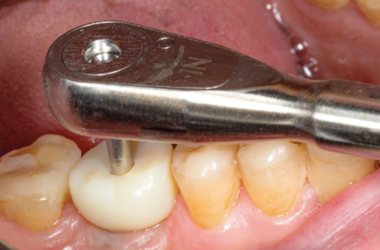 Pinze Per Rimozione Corone Dentali Ponti E Corone Strumenti Di Rimuovere Manuale - Foto 8