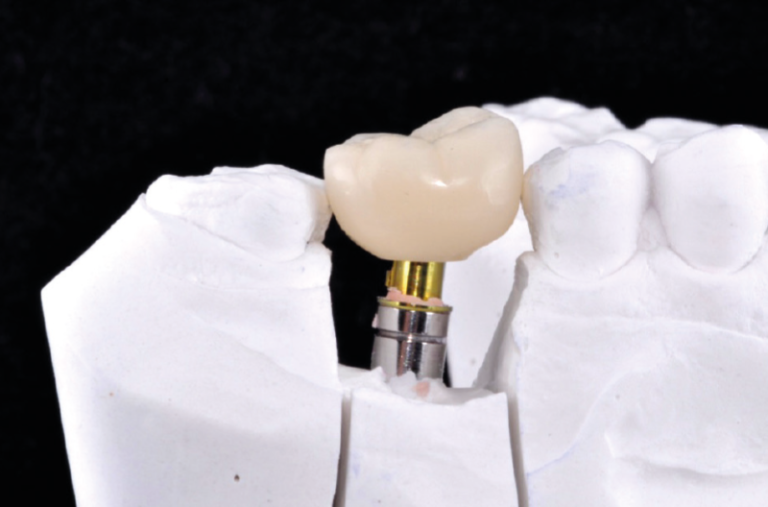 Corona individual en composite sobre implante XCN® y ExaConnect Casos