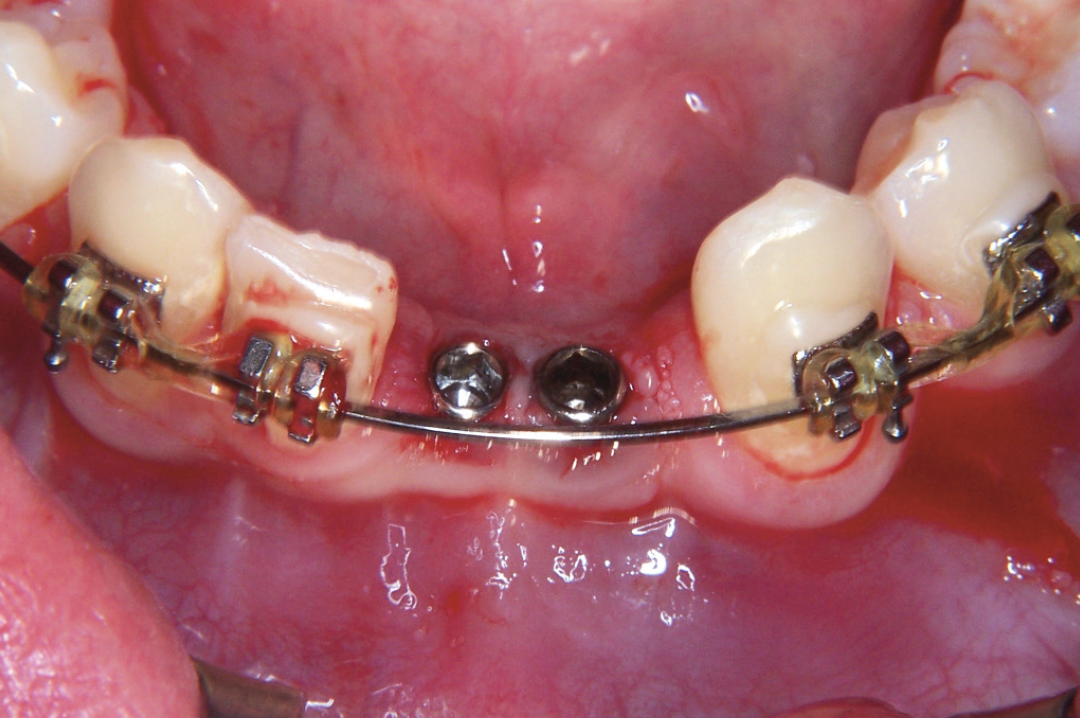 agenesia di tutti i dentist agenesia di tutti i dentist